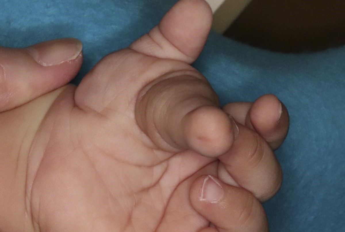 30-facts-about-polydactyly-middle-ray-duplication