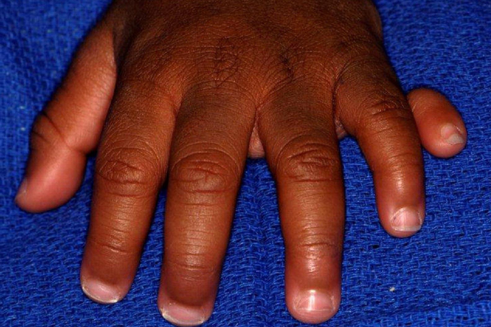 30-facts-about-polydactyly-postaxial-with-median-cleft-of-upper-lip