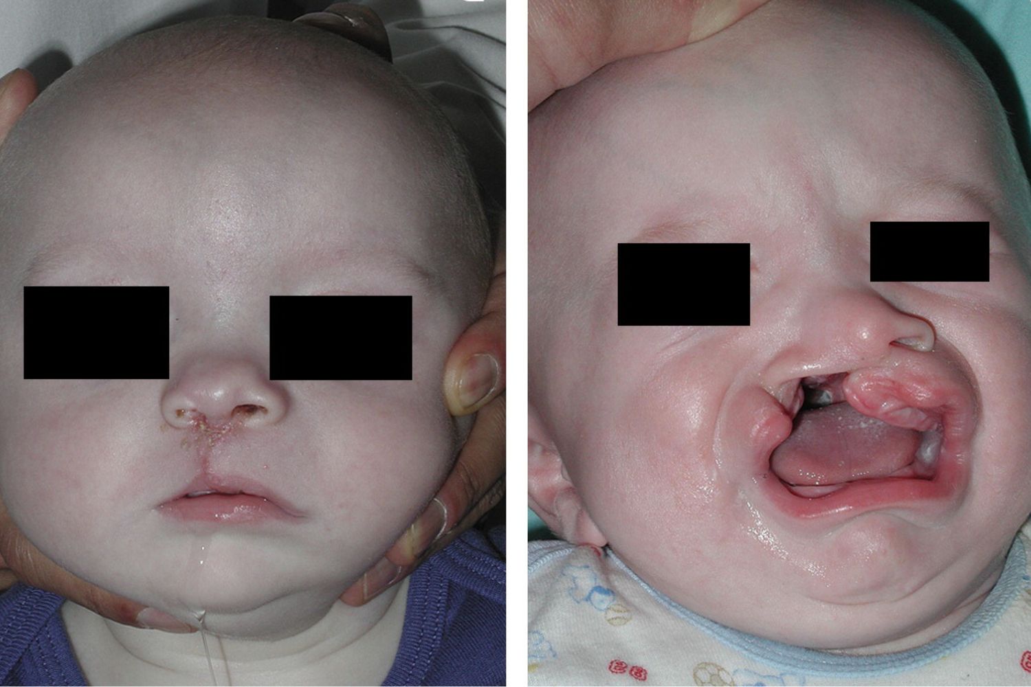 30-facts-about-polydactyly-visceral-anomalies-cleft-lip-palate