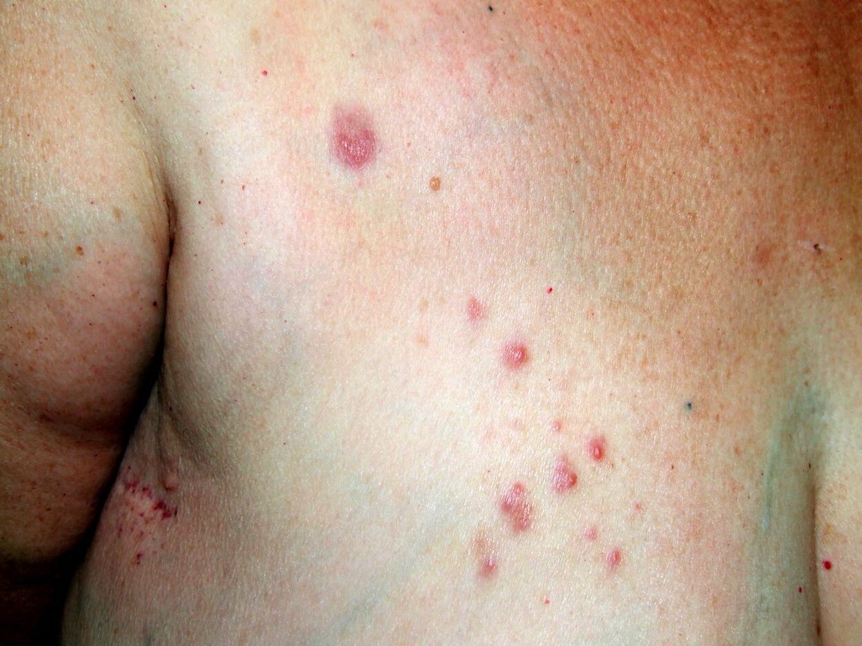 30-facts-about-primary-cutaneous-follicular-lymphoma