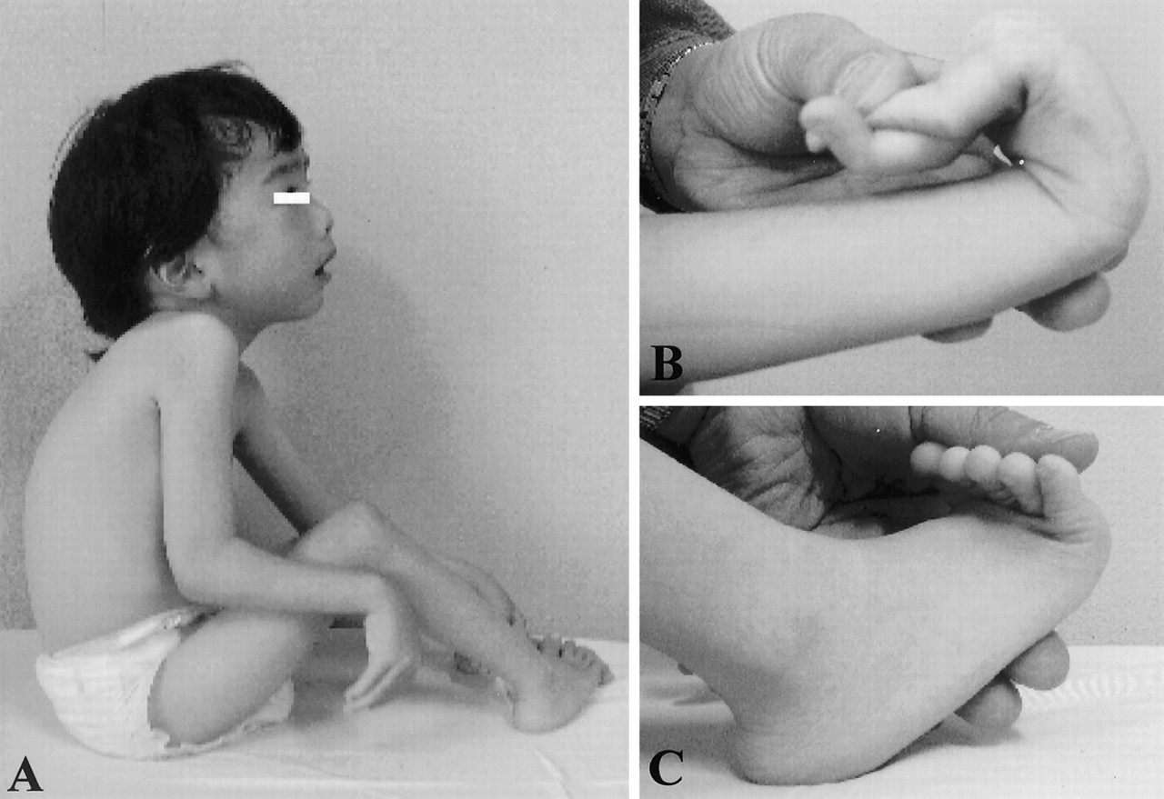 30-facts-about-scleroatonic-myopathy