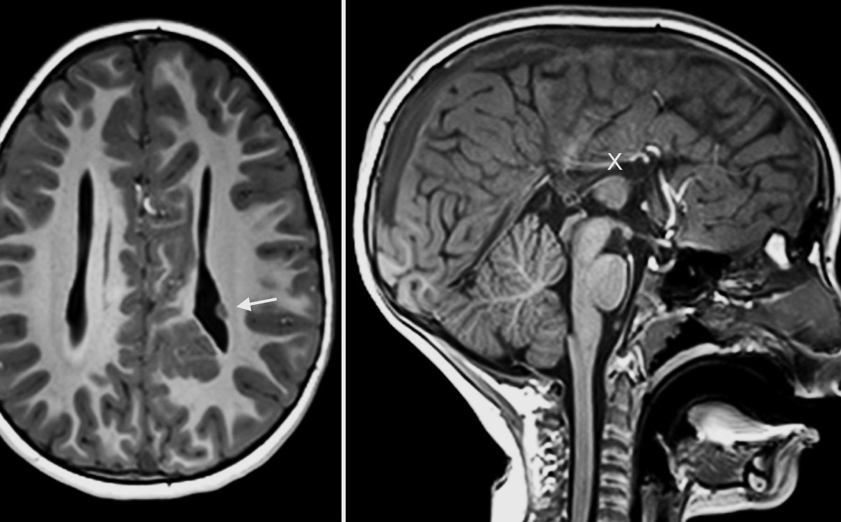 30-facts-about-subependymal-nodular-heterotopia