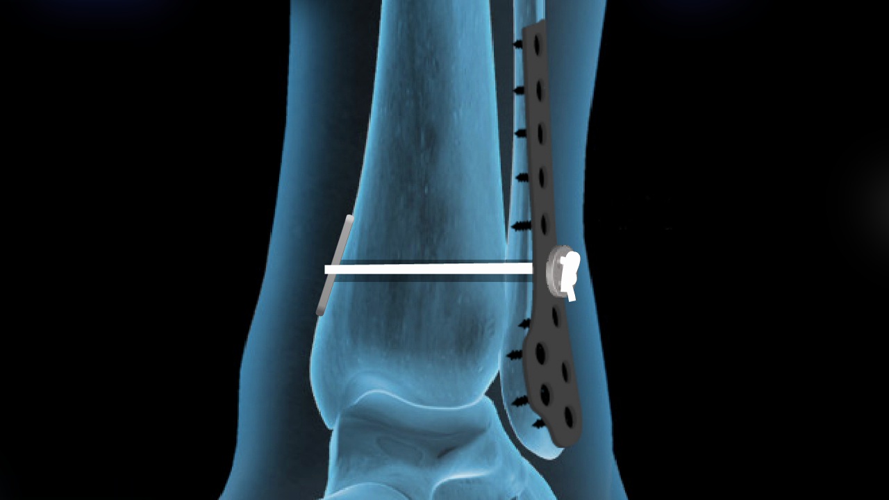 30-facts-about-syndesmosis-procedure