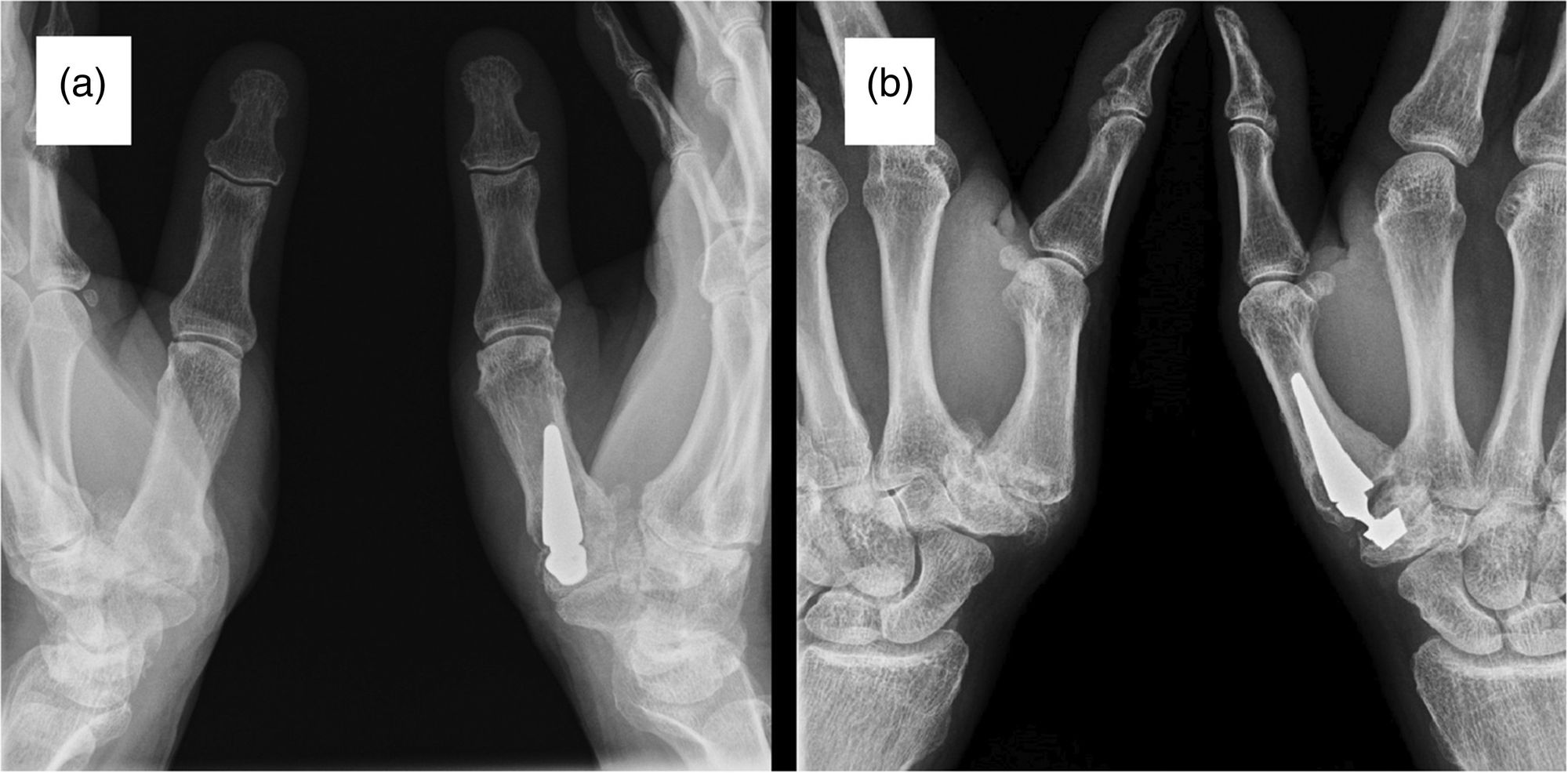 30-facts-about-trapeziometacarpal-osteoarthritis