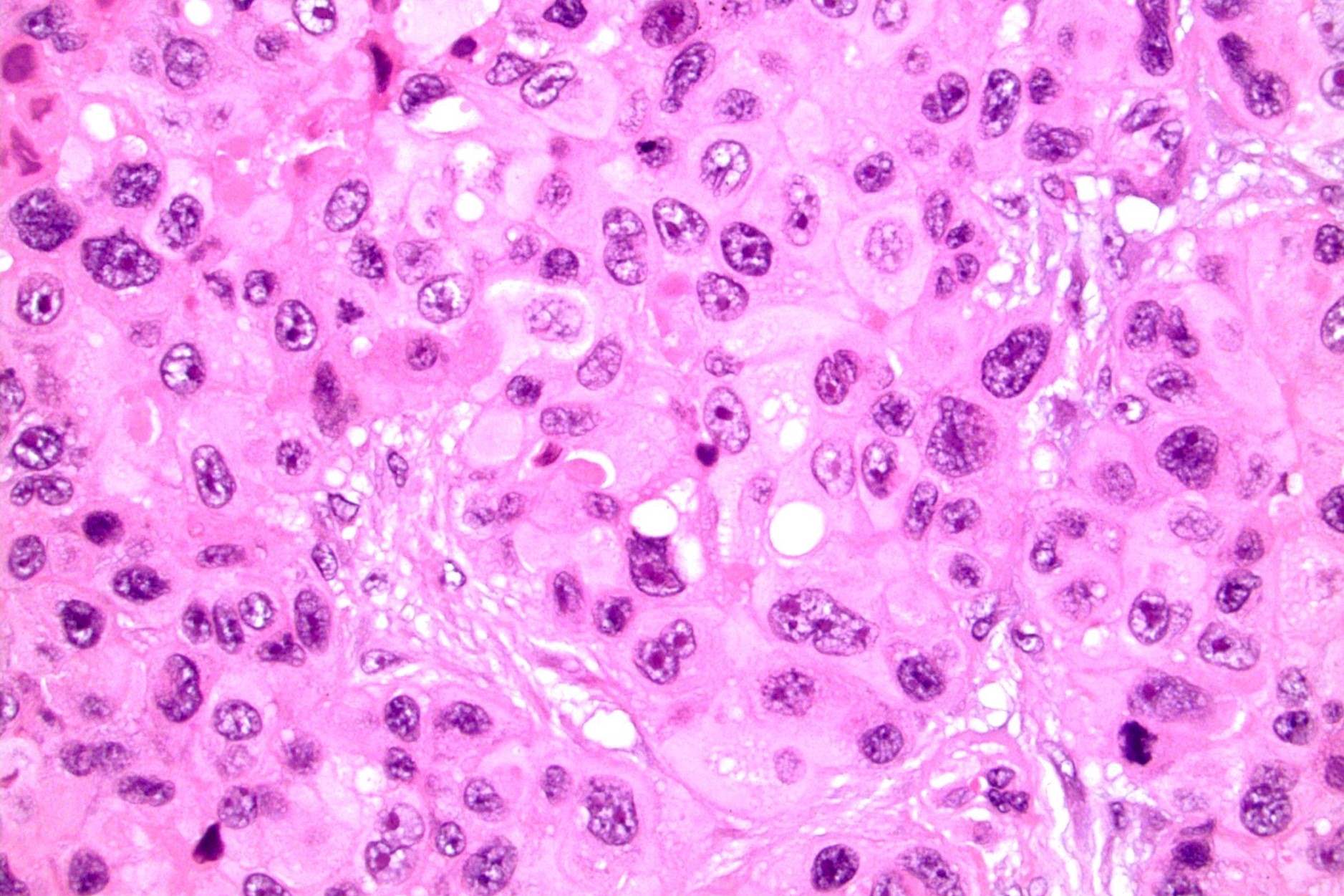 30-facts-about-trophoblastic-neoplasms