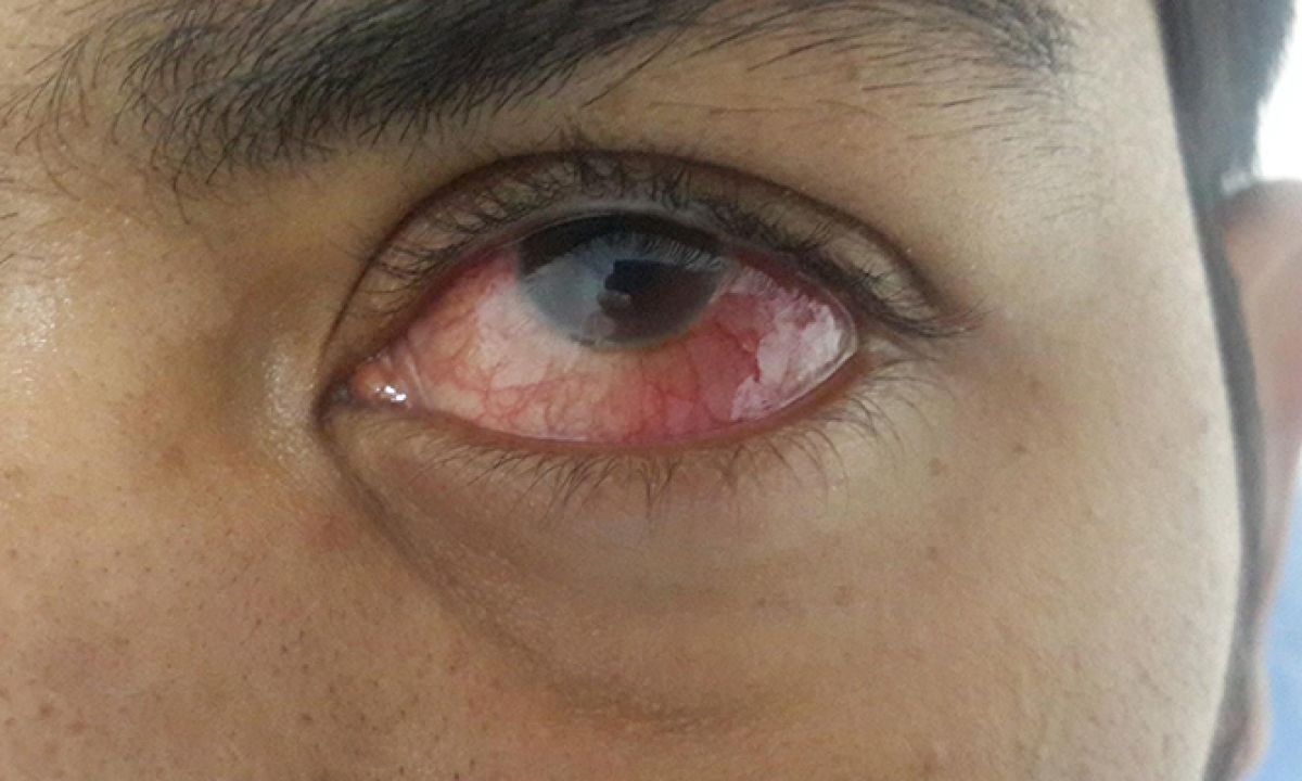 30-facts-about-tuberculous-uveitis