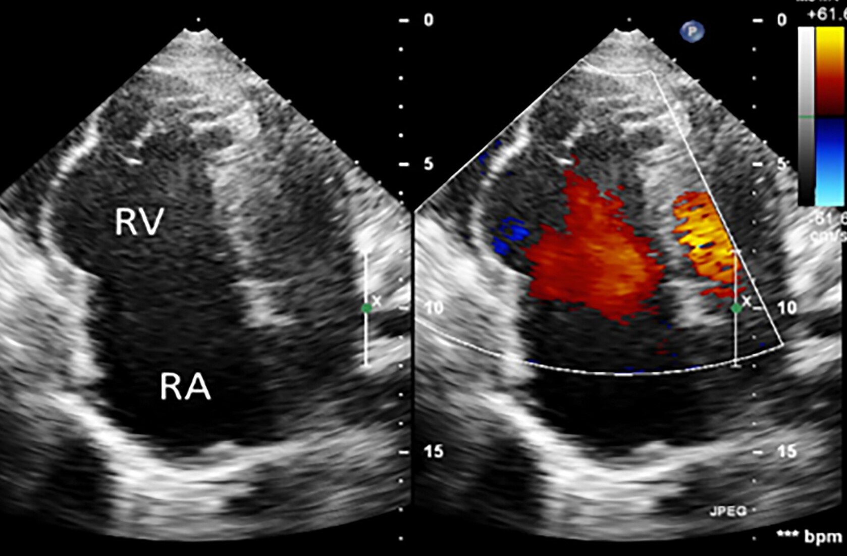 30-facts-about-uhl-anomaly