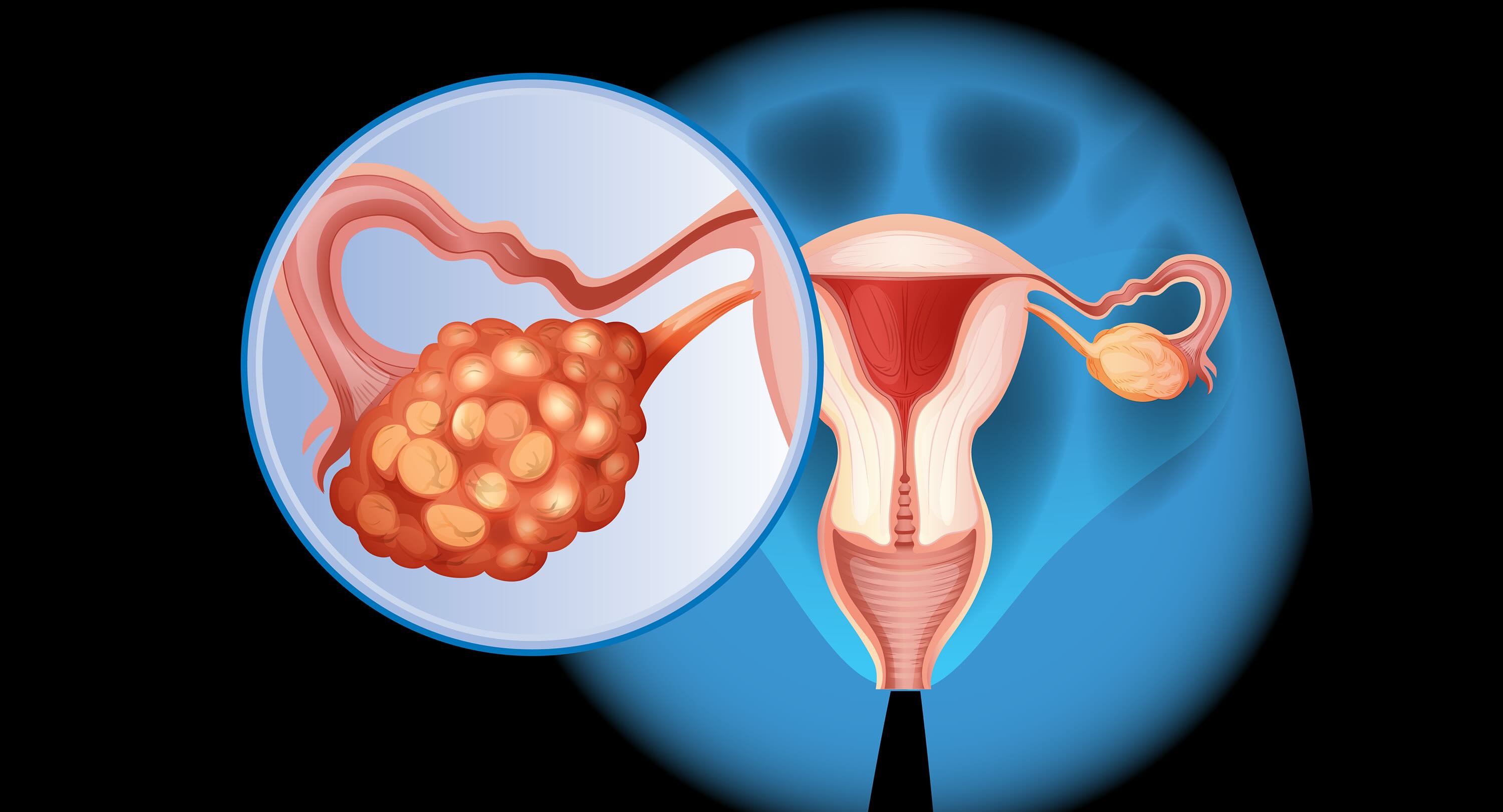 35-facts-about-ovarian-carcinosarcoma