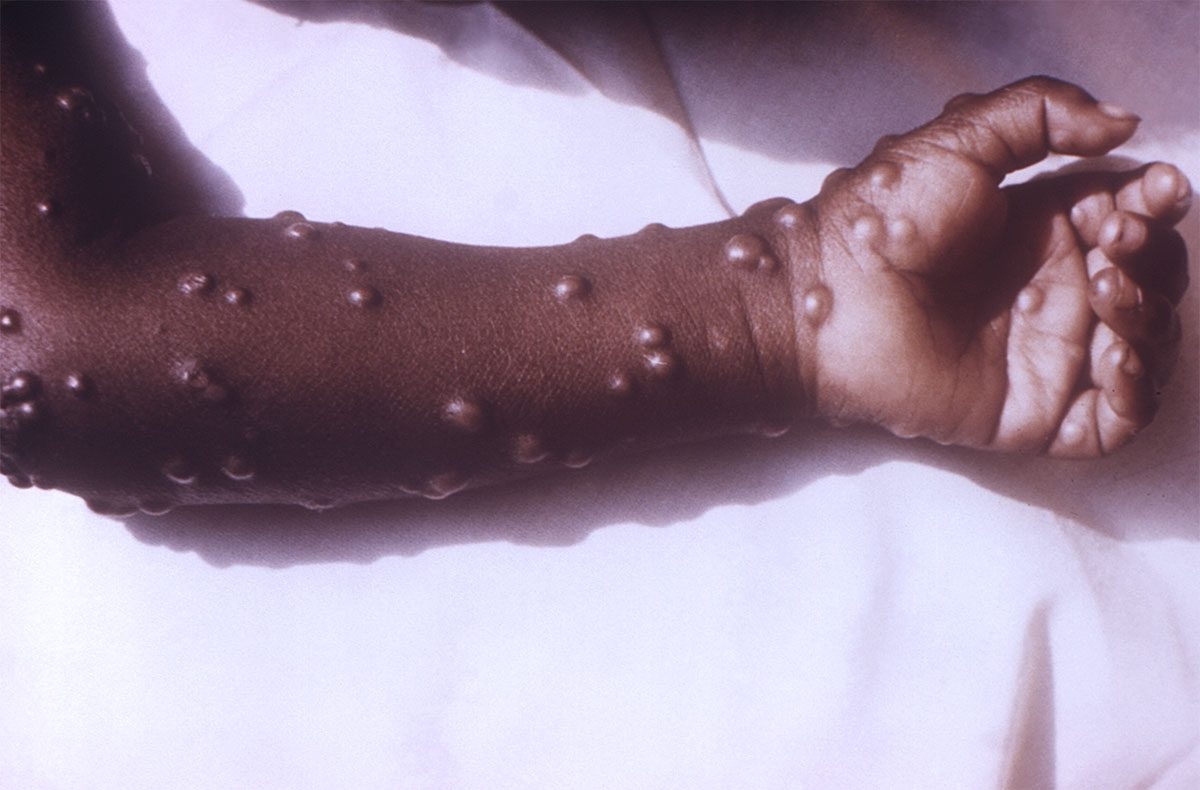 37-facts-about-smallpox