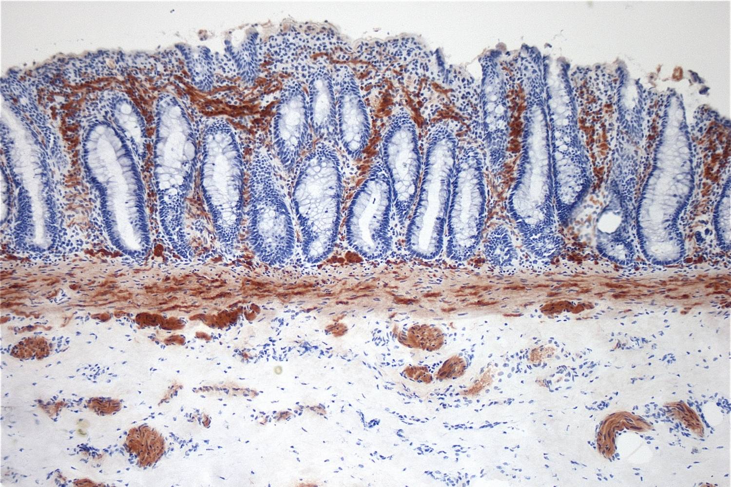 40-facts-about-congenital-megacolon