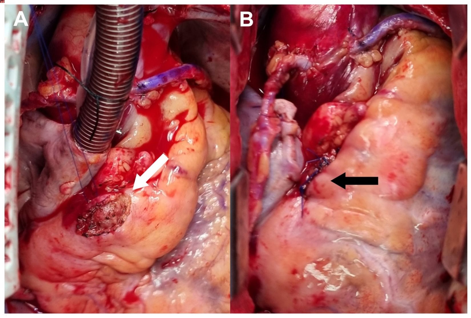 40-facts-about-coronary-artery-aneurysm