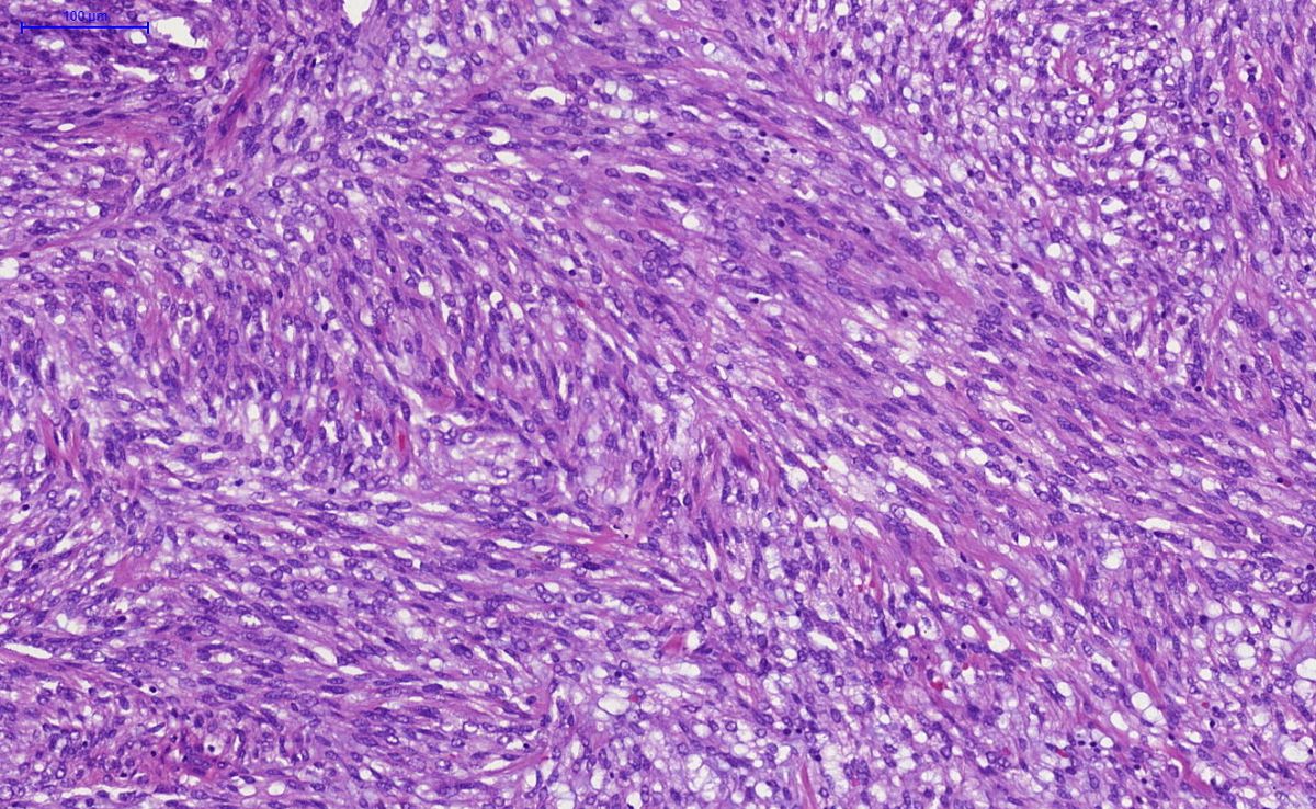 40-facts-about-endometrial-stromal-sarcoma