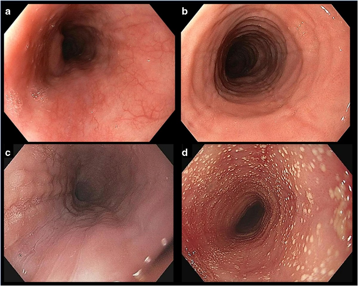 40-facts-about-eosinophilic-gastroenteritis