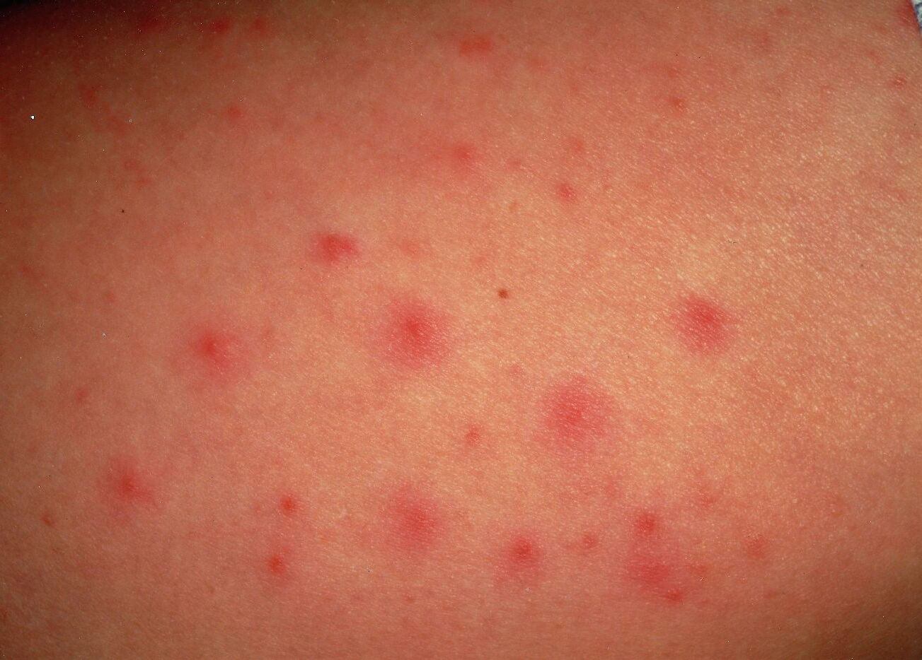 40-facts-about-eosinophilic-pustular-folliculitis