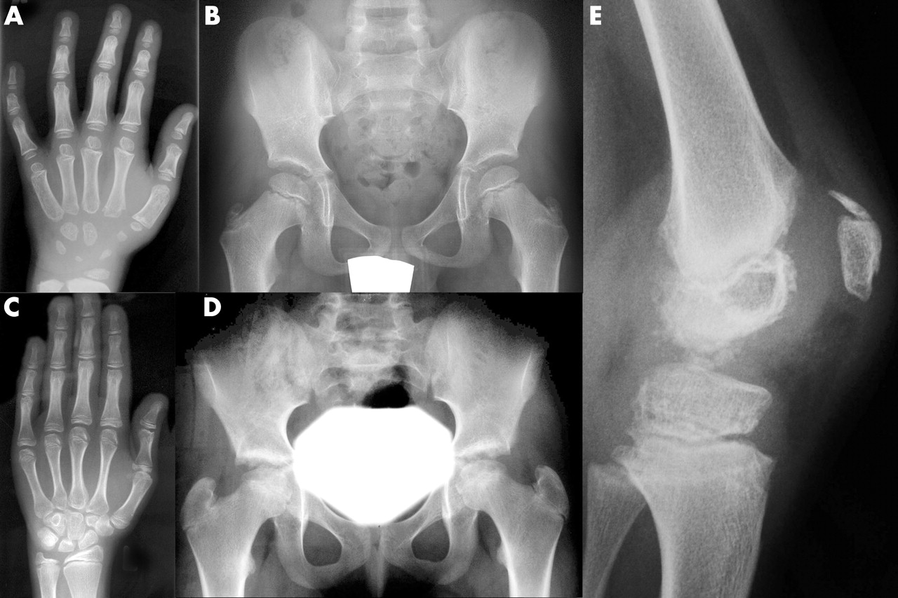 40-facts-about-epiphyseal-dysplasia