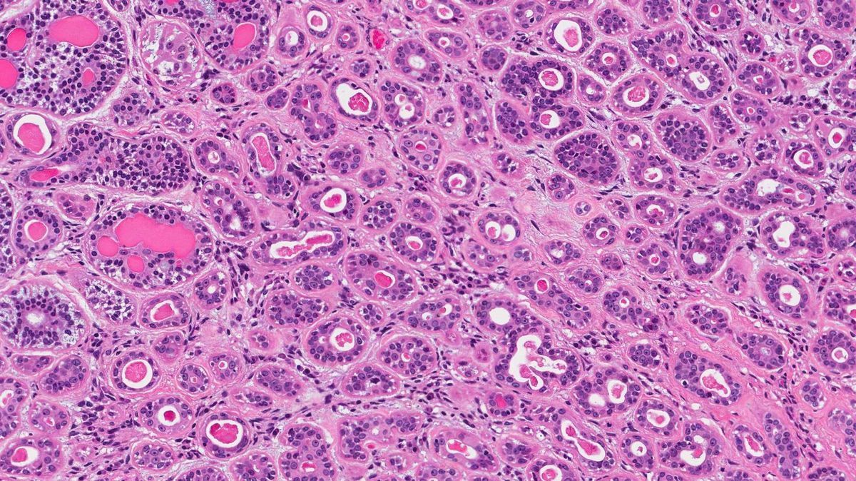 40-facts-about-epithelial-myoepithelial-carcinoma