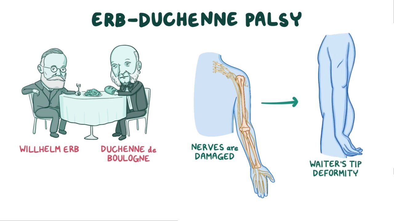 40-facts-about-erb-duchenne-palsy