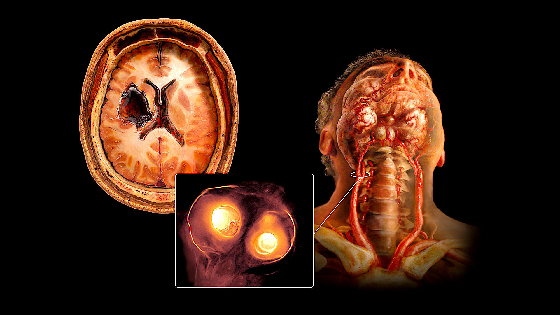 40-facts-about-fibromuscular-dysplasia-of-arteries