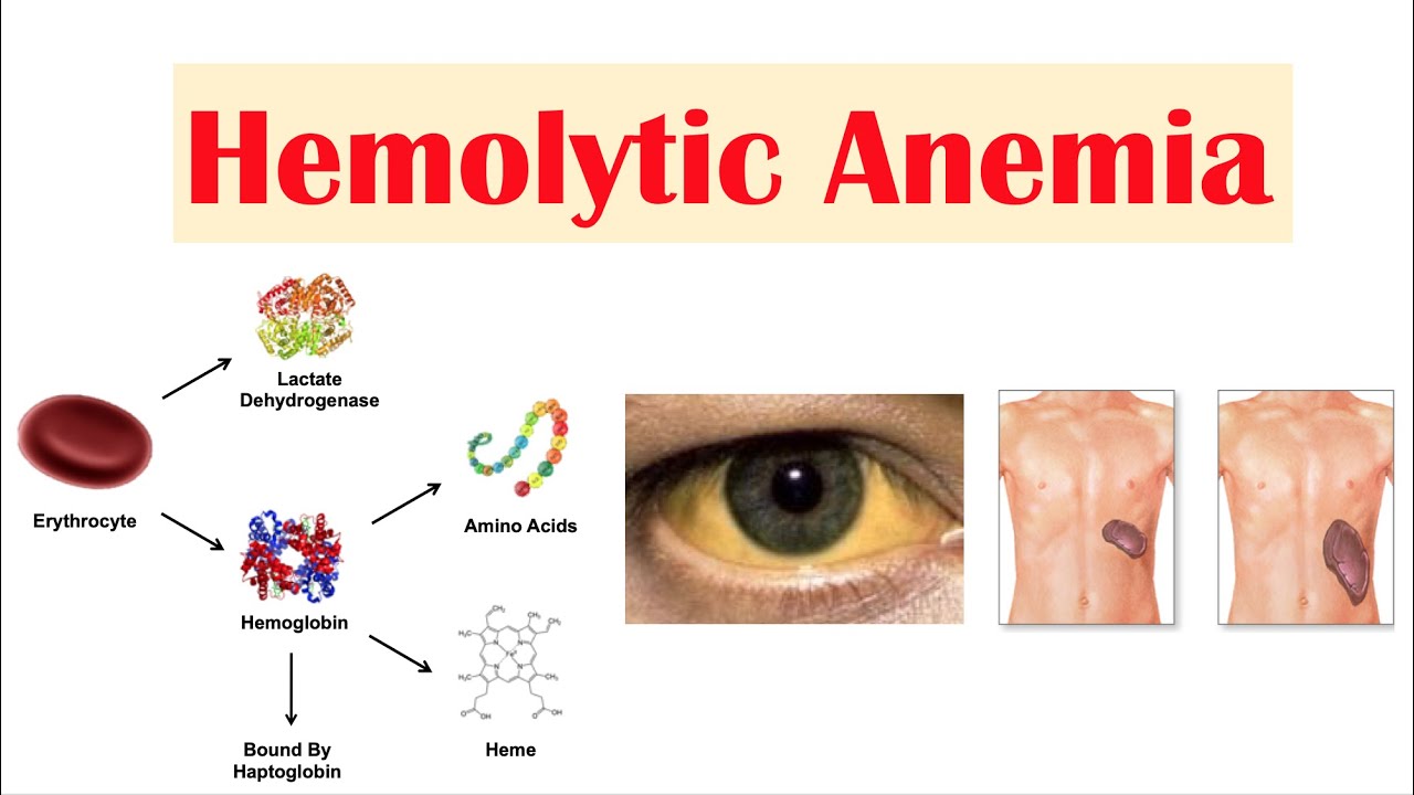 40-facts-about-hereditary-non-spherocytic-hemolytic-anemia