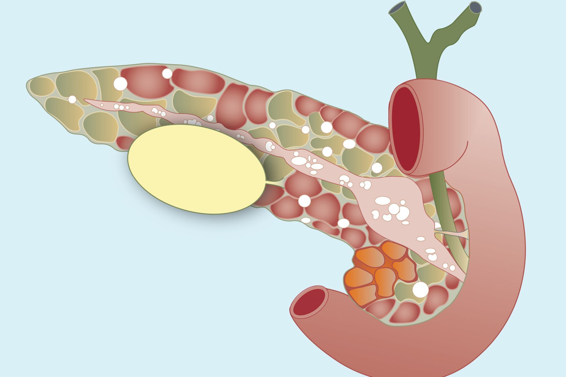 40-facts-about-hereditary-pancreatitis