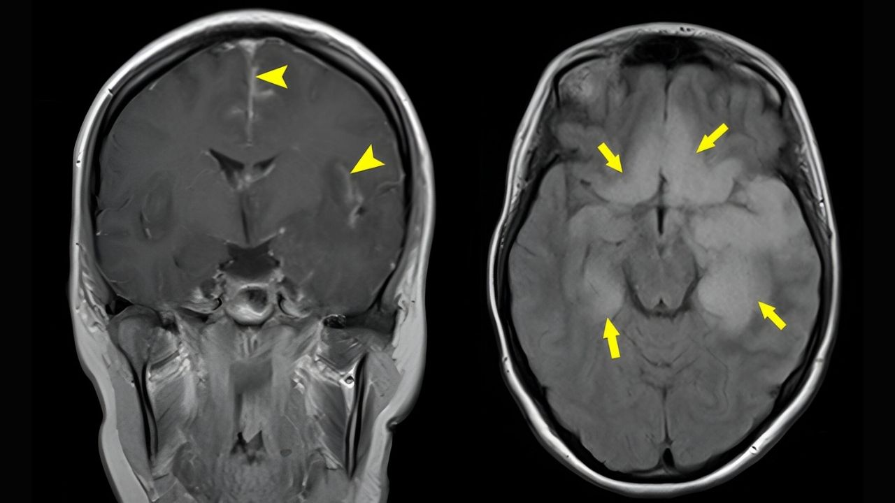 40-facts-about-herpes-simplex-encephalitis