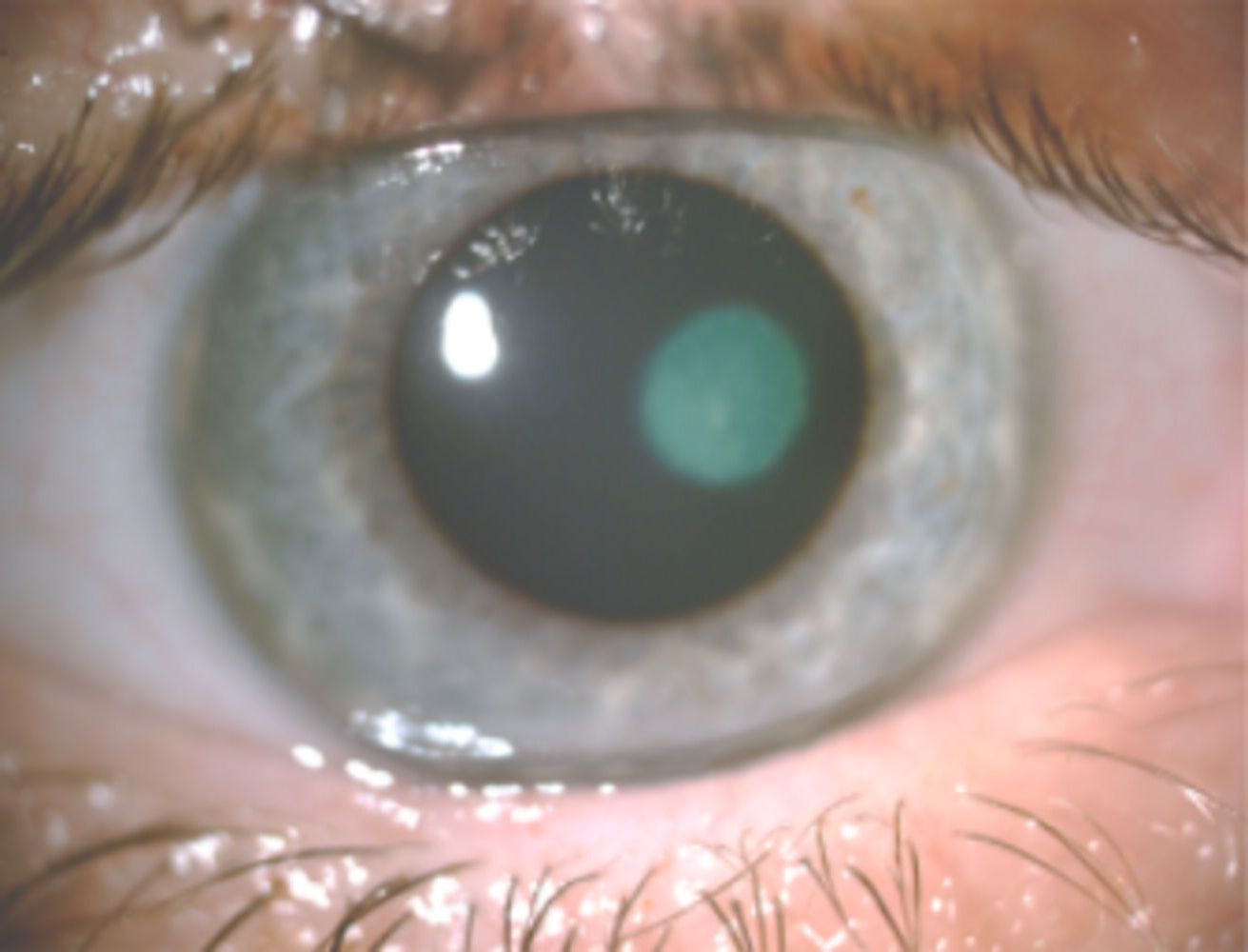 40-facts-about-herpetic-keratitis