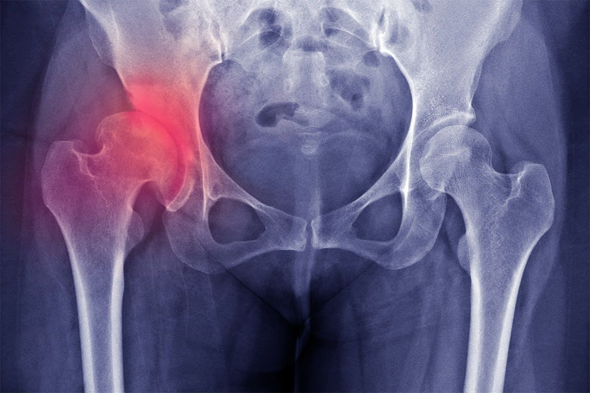 40-facts-about-hip-dysplasia-in-humans