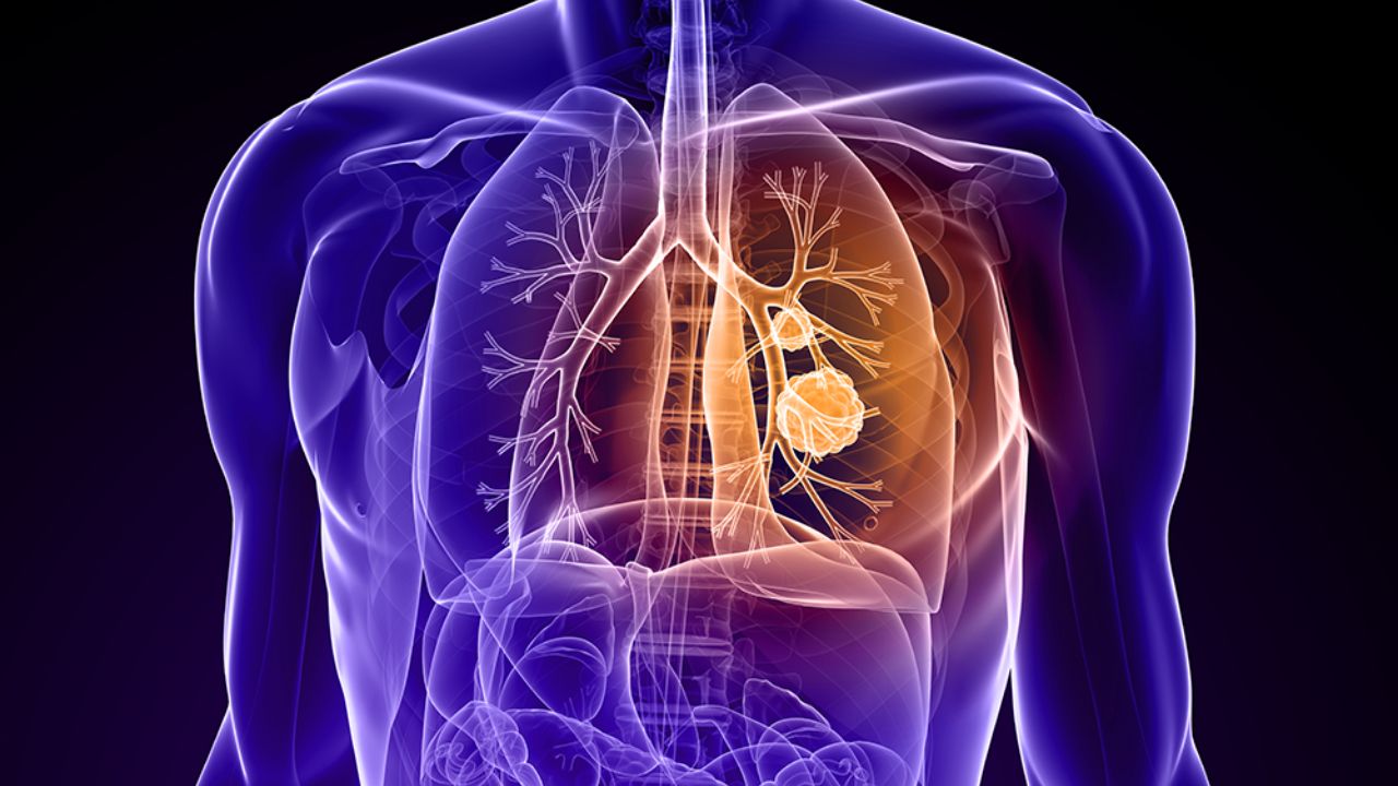 40-facts-about-lung-neoplasm