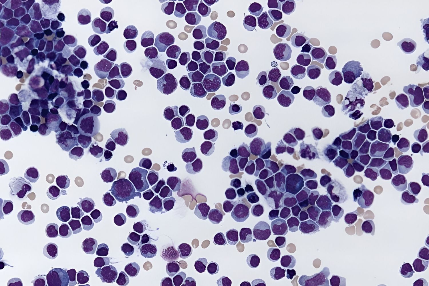 40-facts-about-lymphocytic-pleocytosis