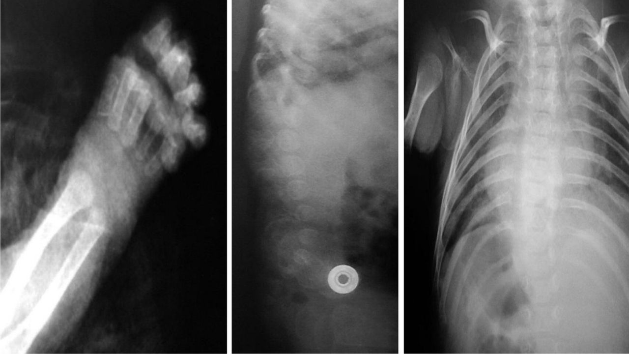 40-facts-about-microcephalic-osteodysplastic-primordial-dwarfism