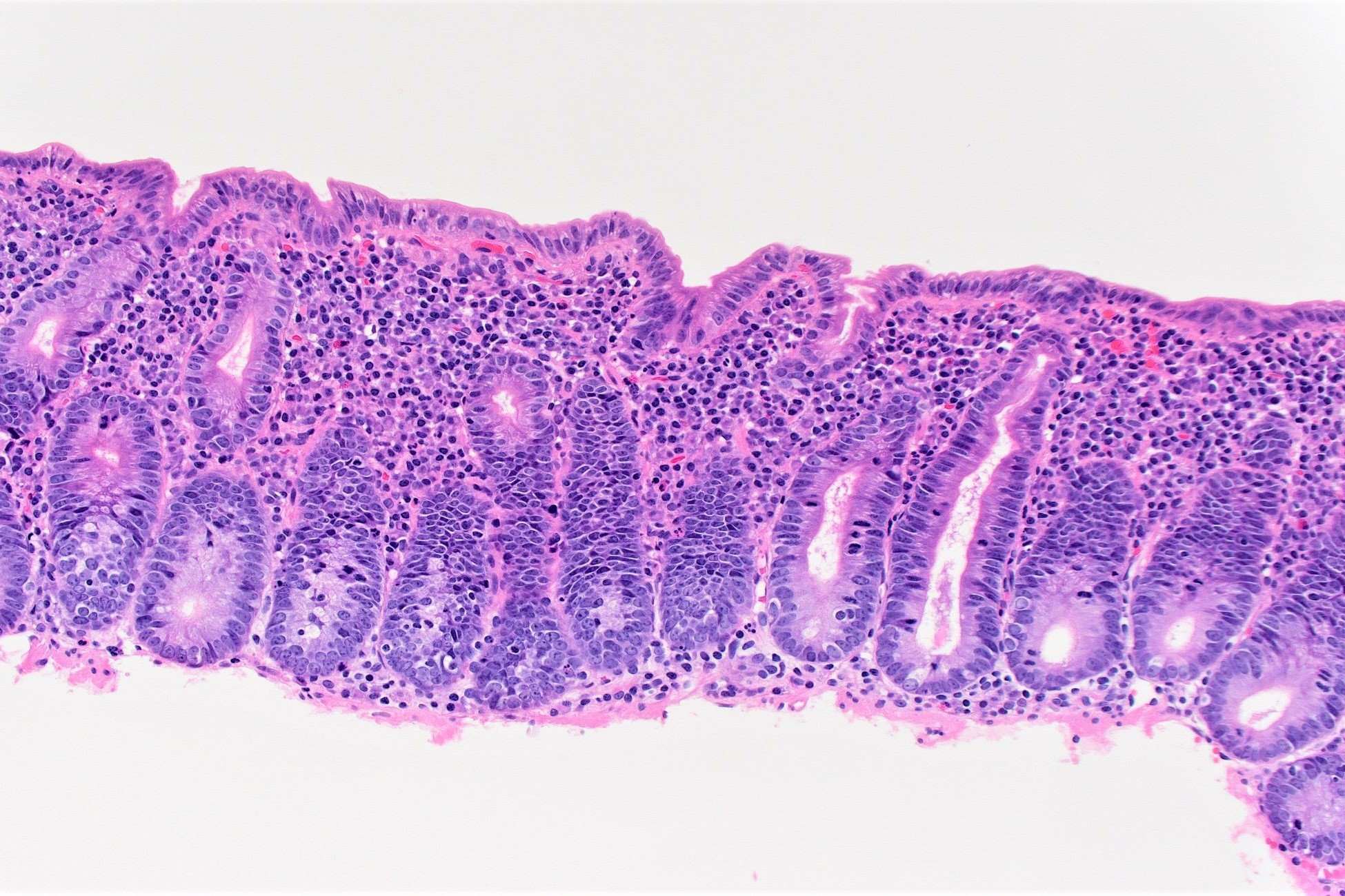 40-facts-about-microvillus-inclusion-disease