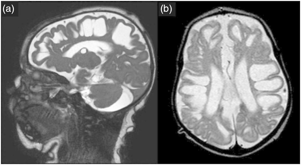 40-facts-about-molybdenum-cofactor-deficiency