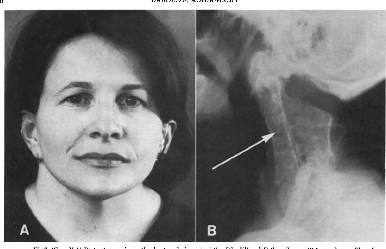 40-facts-about-mondini-dysplasia