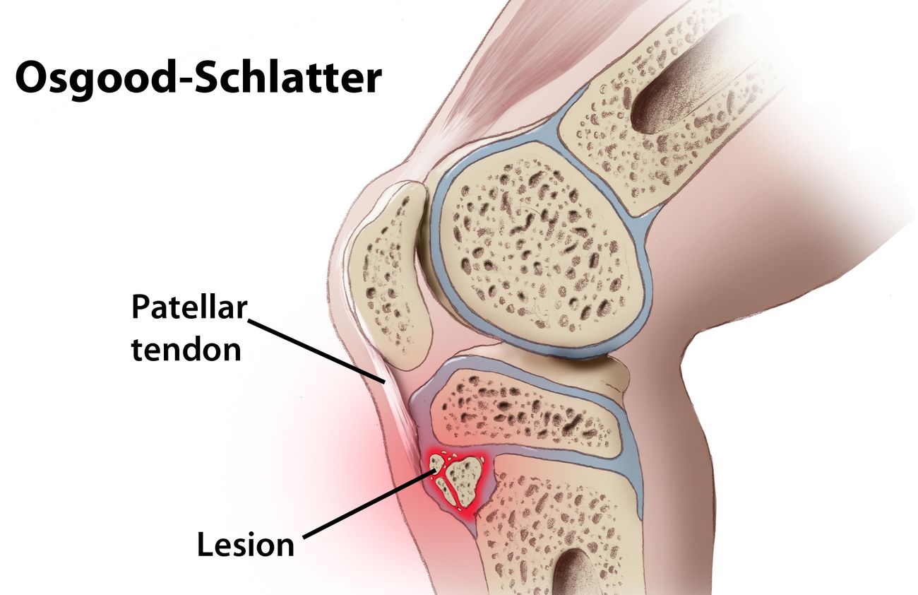 40-facts-about-osgood-schlatter-disease