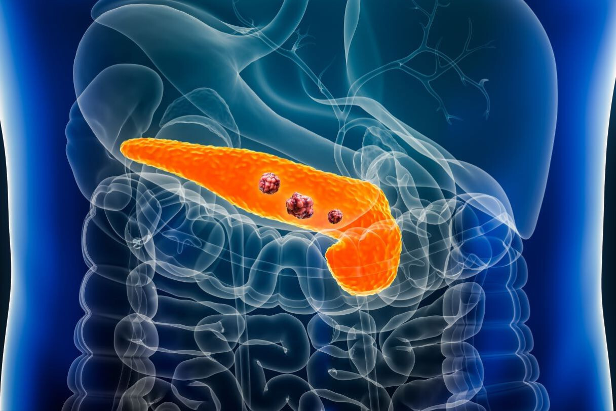 40-facts-about-pancreatic-carcinoma