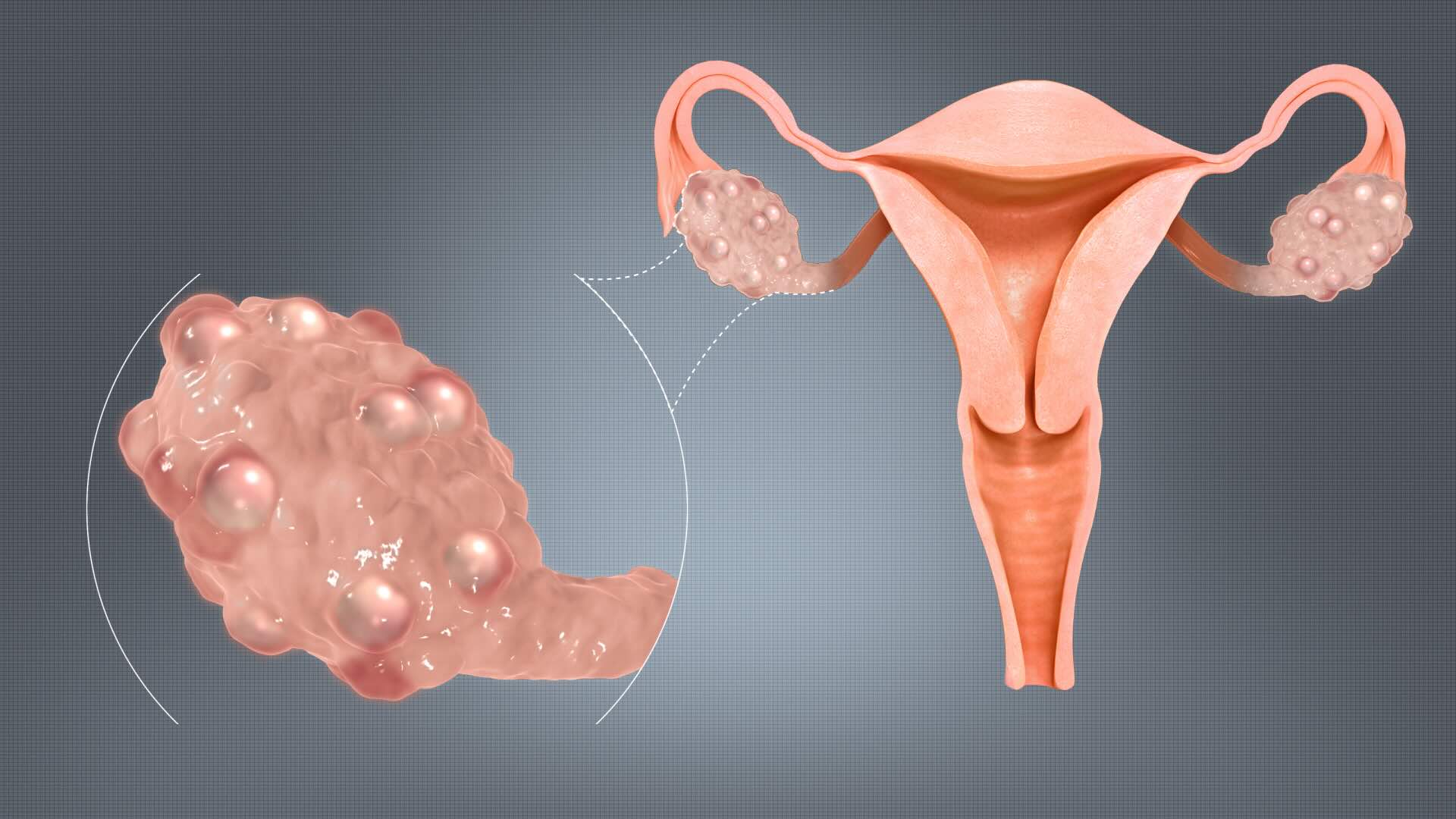 40-facts-about-polycystic-ovarian-disease