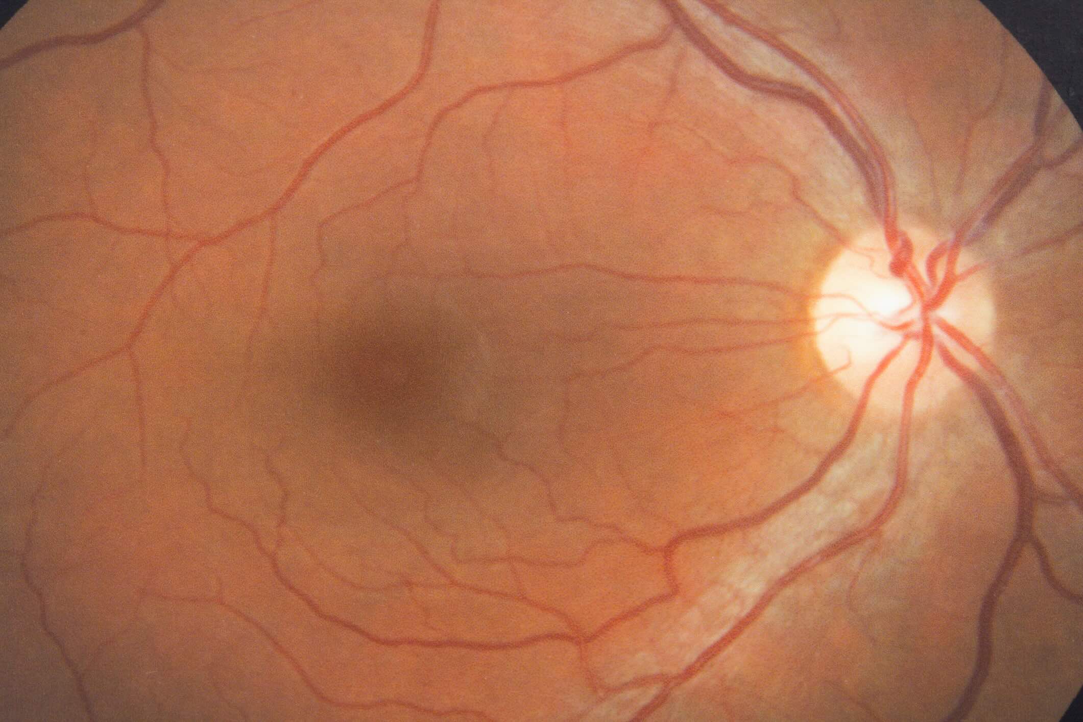 40-facts-about-retinal-degeneration