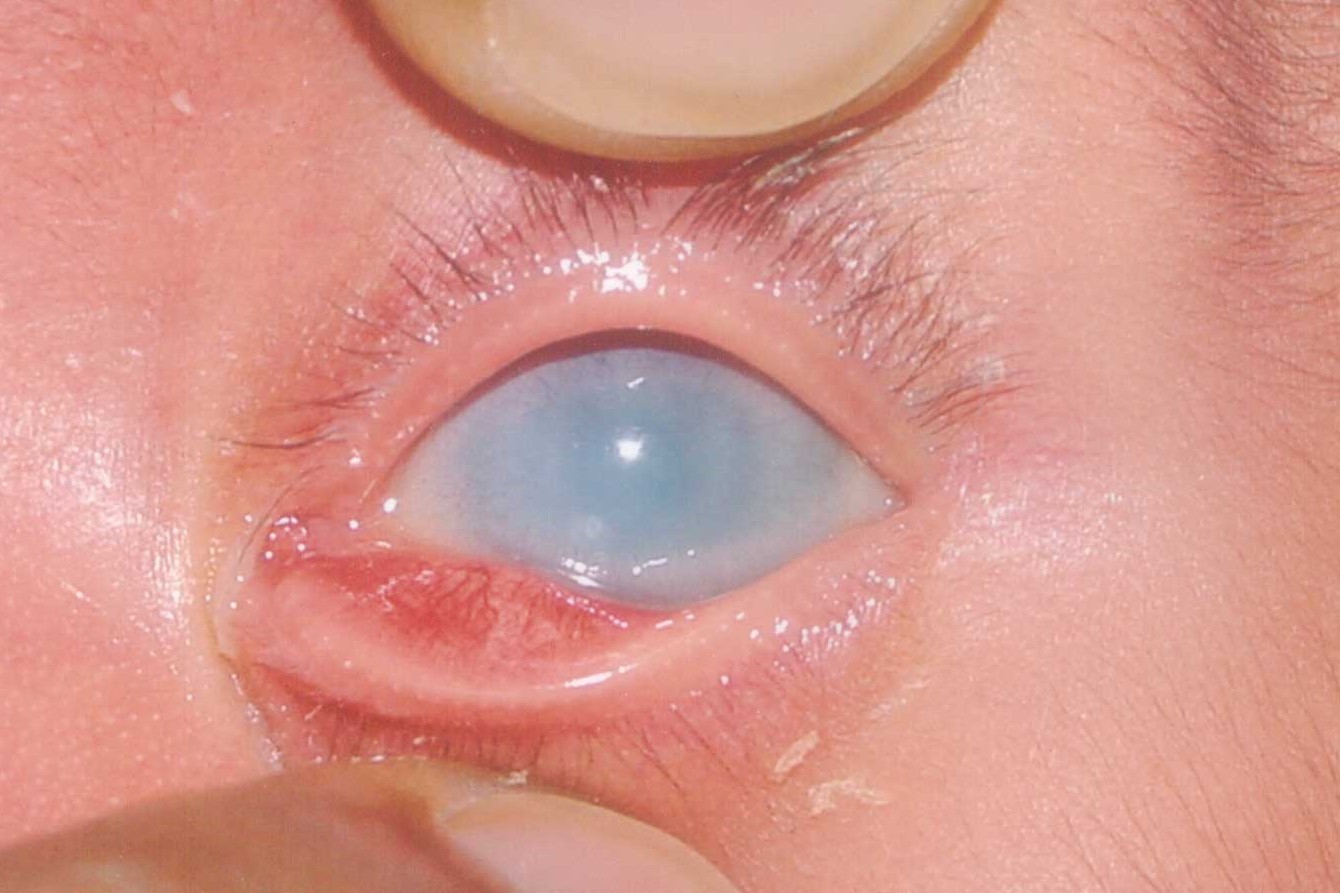 40-facts-about-sclerocornea