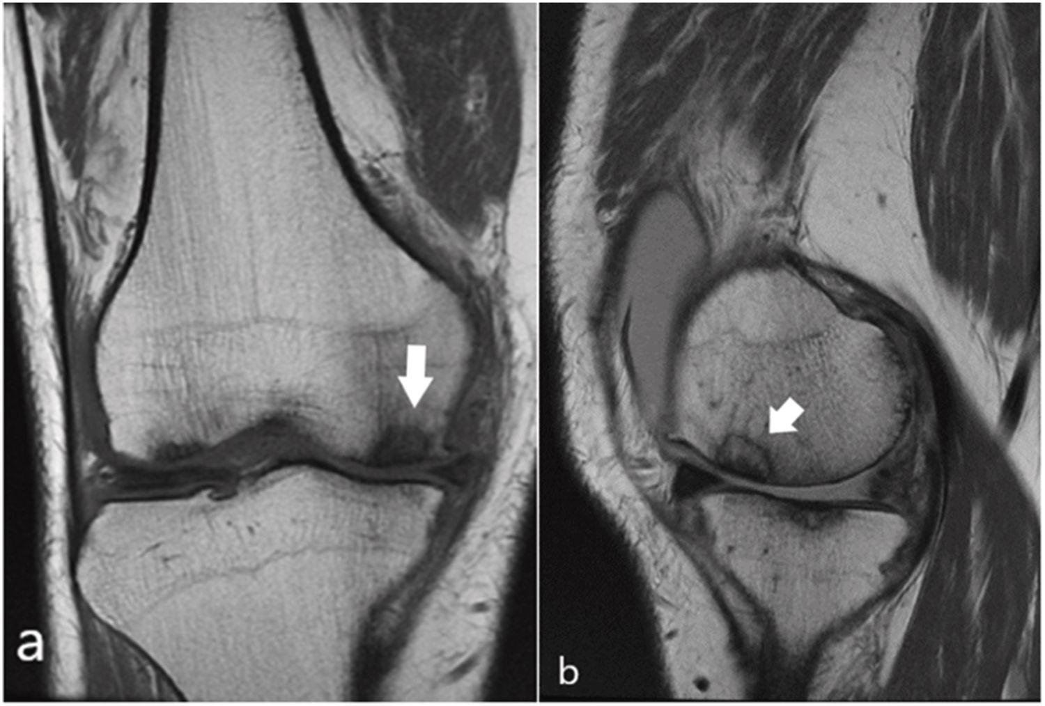 40-facts-about-spontaneous-osteonecrosis-of-the-knee