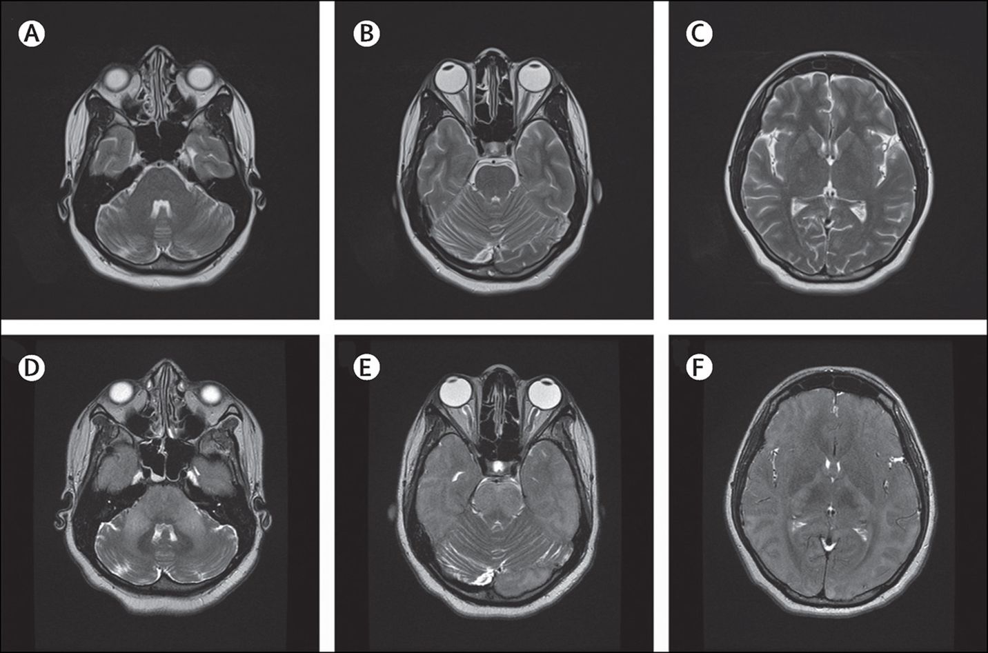 40-facts-about-subacute-sclerosing-panencephalitis