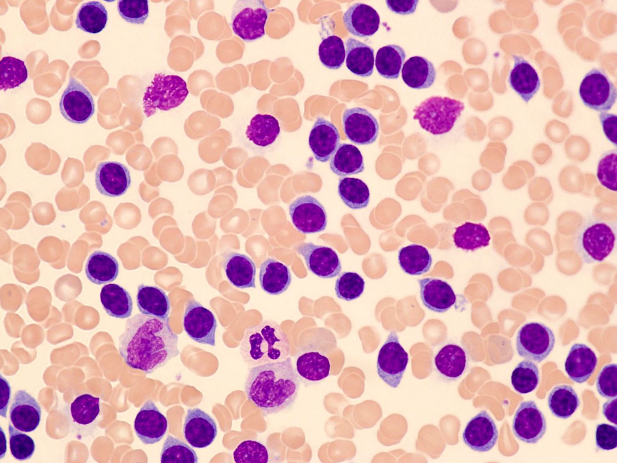 40-facts-about-t-cell-prolymphocytic-leukemia