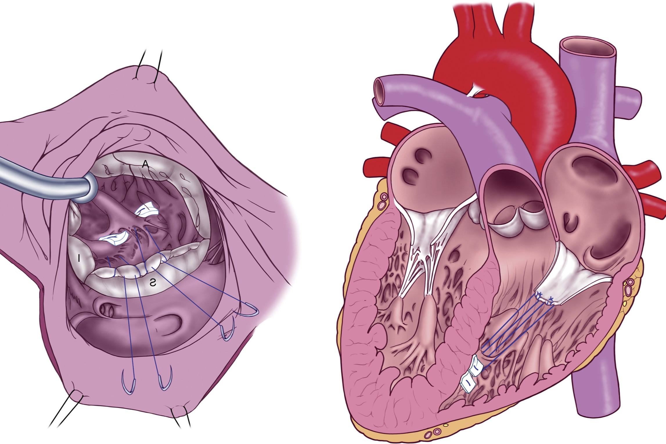 40-facts-about-tricuspid-dysplasia