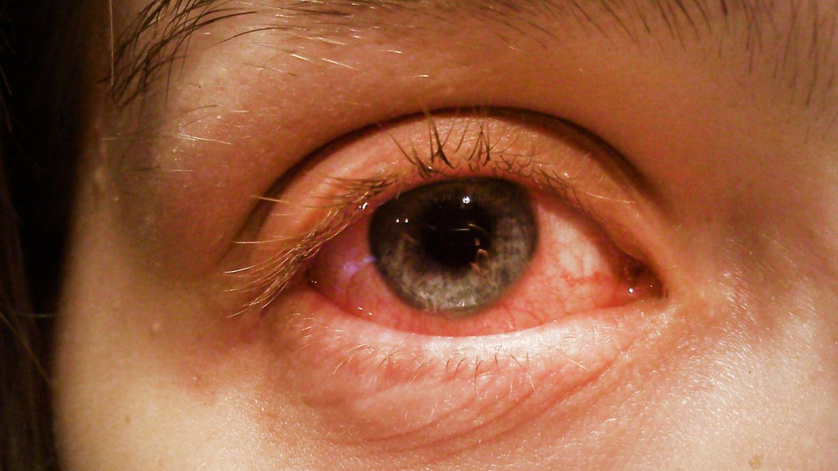 50-facts-about-conjunctivitis