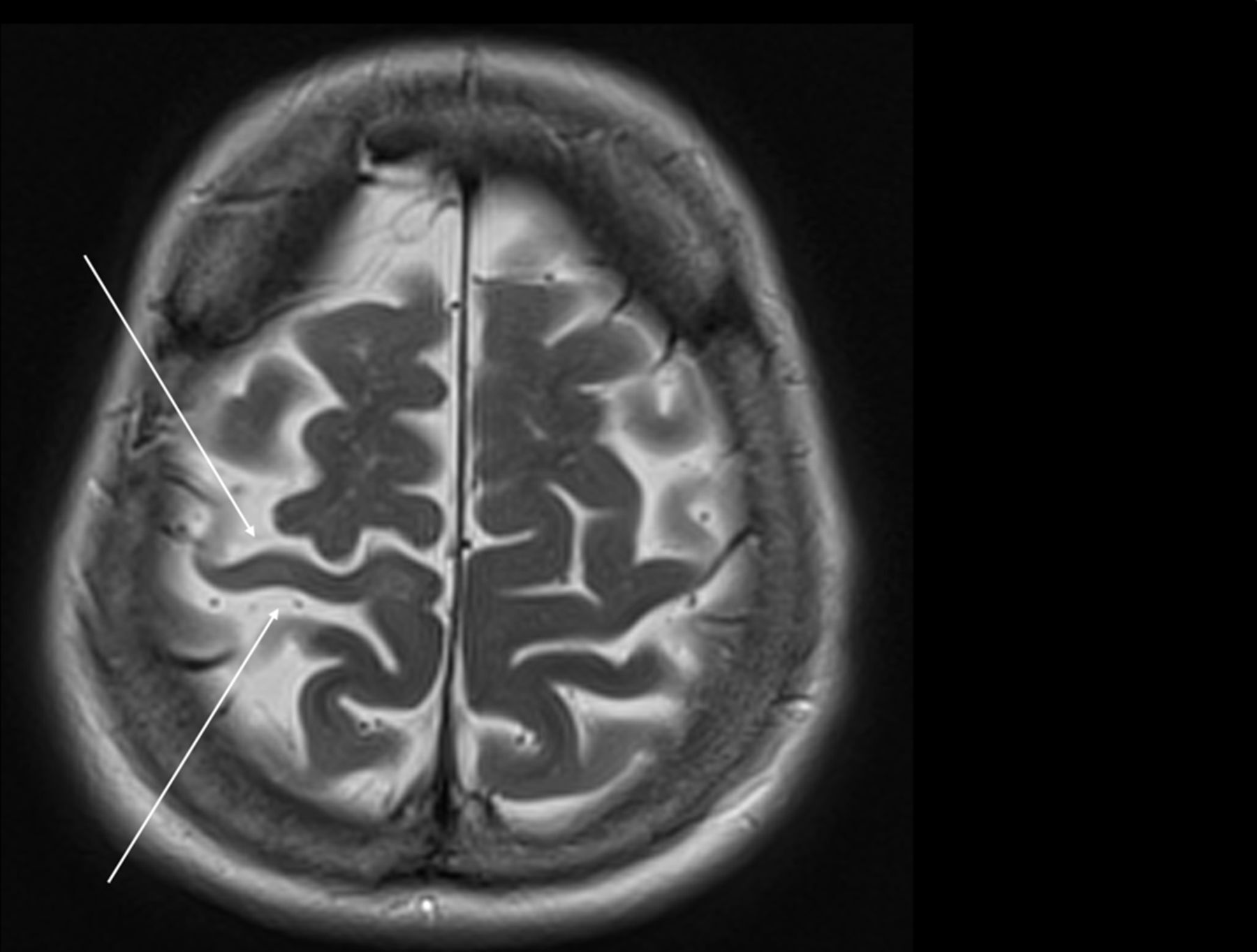 50-facts-about-corticobasal-degeneration