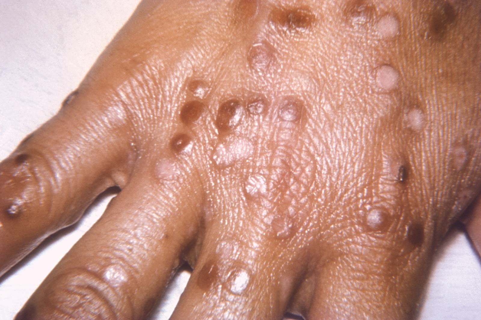 50-facts-about-cowpox