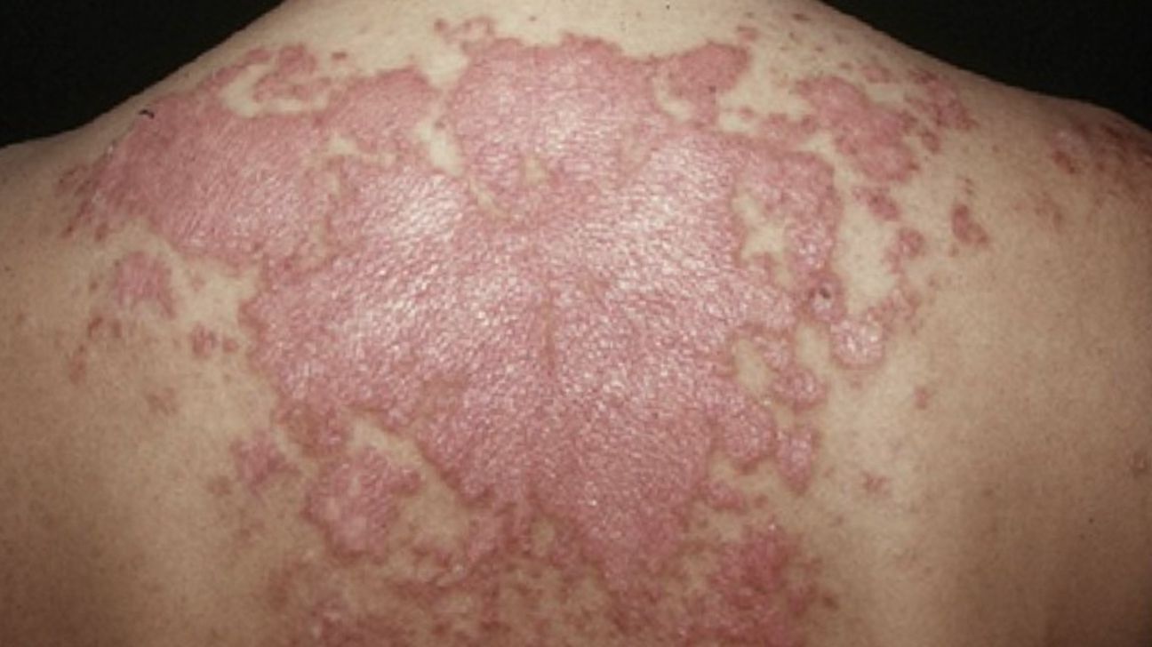 50-facts-about-cutaneous-lupus-erythematosus