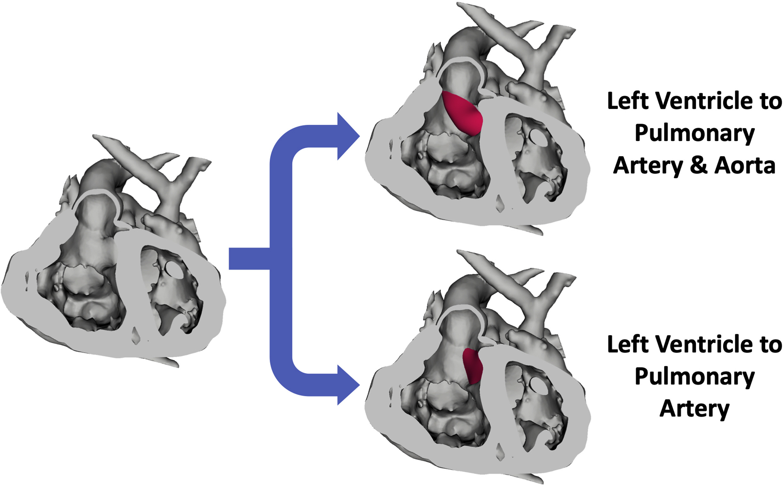 50-facts-about-double-outlet-right-ventricle