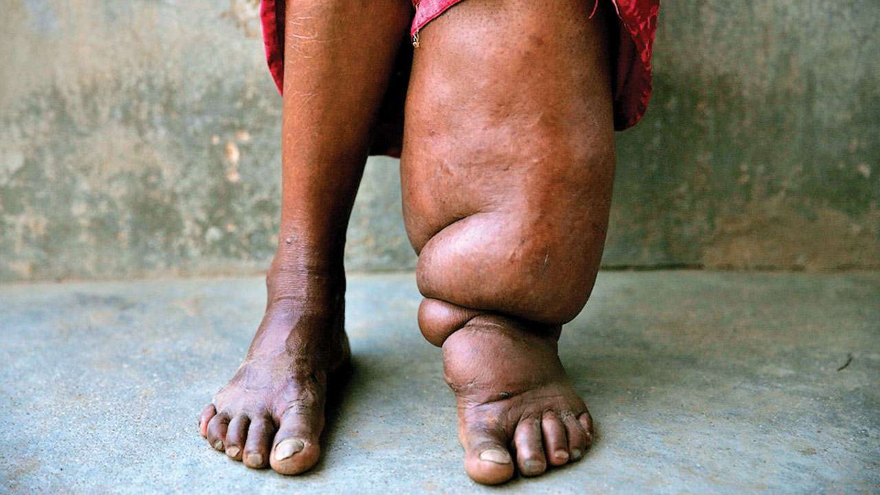 50-facts-about-elephantiasis