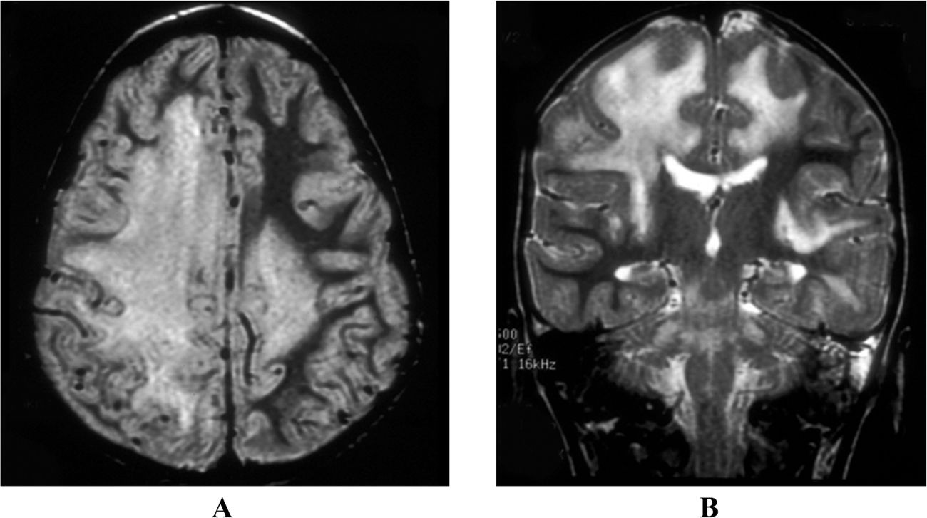 50-facts-about-encephalomyelitis