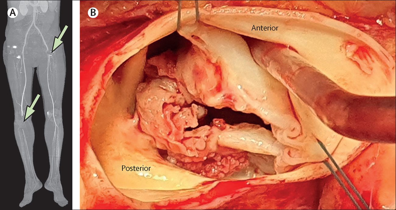 50-facts-about-endocarditis